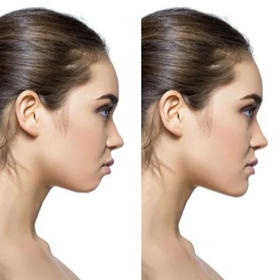 جراحی زیبایی بینی